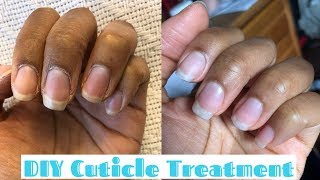 How to Fix Dry Cuticles DIY nail treatment [upl. by Aihtiekal214]