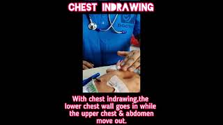 Chest indrawingRespiratory DistressNewborn babyNeonatology [upl. by Trutko]