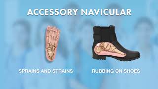 What is Accessory Navicular  Ask Dr Silverman [upl. by Nageam]