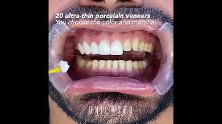 Porcelain veneers This is how we do it [upl. by Adiell336]