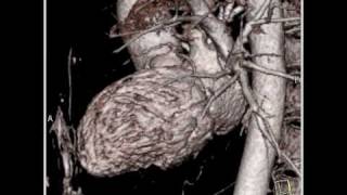 Cardiac perfectly timed cardiac CT angiographic study with normal anatomy 1 of 16 [upl. by Une]