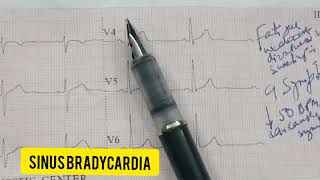 SINUS BRADYCARDIA PART 1ECG test ECG रिपोर्ट कैसे देखें। [upl. by Biron617]