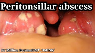 Peritonsillar abscess [upl. by Muhcon]