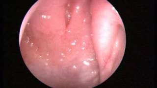 Video 1 Normal nasal endoscopy [upl. by Teriann]