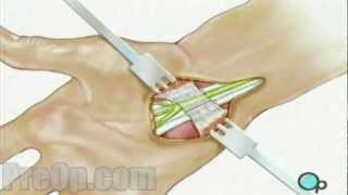 Carpal Tunnel Syndrome Repair Surgery  PreOp® Patient Education Medical HD [upl. by Hagar]