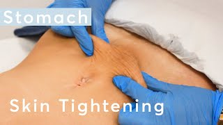 Skin Tightening Stomach  HIFU Ultraformer III Treatment [upl. by Ashley]