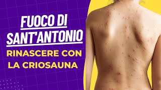 Fuoco di SantAntonio Herpes Zoster  Il rimedio è la Criosauna [upl. by Annaeerb]