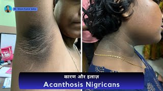 Acanthosis nigricans Treatment  dark neck treatment  काले गर्दन का इलाज  Dr Uttam Kumar Lenka [upl. by Pavla715]