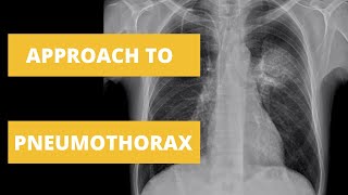 Approach to Pneumothorax  How to Read a Chest X Ray [upl. by Nigam]