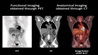 PETCT Positron Emission Tomography  Computed Tomography [upl. by Klotz]