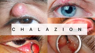 Chalazion  Ophthalmology  EASY MBBS [upl. by Rugen648]