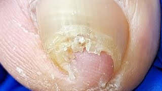 Amazing Such curly ingrown nails【Xue Yidao】 [upl. by Lerrej638]