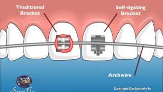 Vincent Team Orthodontics SelfLigating Braces [upl. by Terryn]