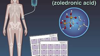 Zoledronate in Osteopenia [upl. by Ambrosane579]