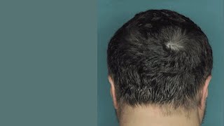 Drug Restores Hair Growth in Patients with Alopecia Areata [upl. by Elatsyrk726]