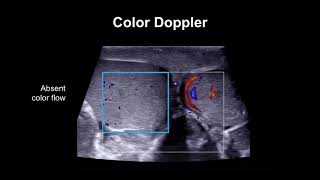 Diagnosing testicular torsion [upl. by Aniretac]