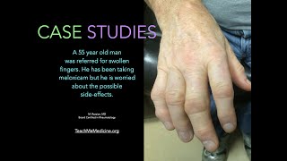 Case Studies Use of NSAIDs for treatment of Oateoarthritis [upl. by Jeremias917]