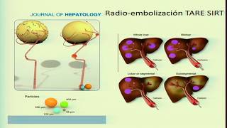 48 Radioembolización con Ytrio en tumores hepáticos manejo Hepatocarcinoma Dr Sergio Alvarez [upl. by Welsh]