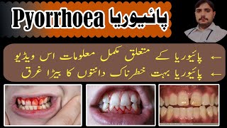 what is PYORRHEA پائیوریا treatment of pyorrhea symptoms information dentalissues treatment [upl. by Gnap]