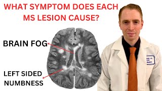 What Symptom Does Each Multiple Sclerosis MRI Lesion Cause Neurologist Explains [upl. by Etnuahs]