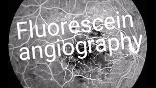 Fluorescein angiography FFA Dye test in eyes [upl. by Brose441]