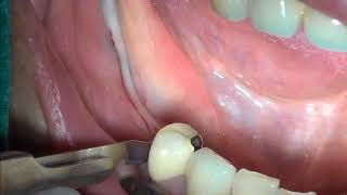 Apical repostioned flap [upl. by Tiersten]