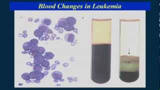 Finding the causes of leukemia [upl. by Ecirted]