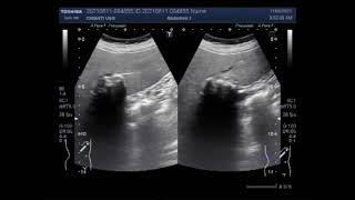 Calcified Hepatic Mass [upl. by Imoan206]