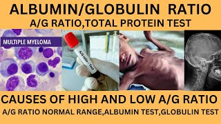 ALBUMIN TO GLOBULIN RATIOAG RATIO TESTHIGH AND LOW AG RATIOAG RATIO INLIVER AND KIDNEY PROBLEM [upl. by Calesta]