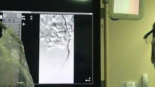 Varicocele Embolization Treatment in Urdu Pakistan [upl. by Eamon243]