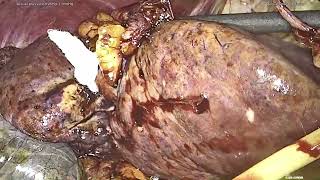 Central hepatectomy HCC [upl. by Nossaj]