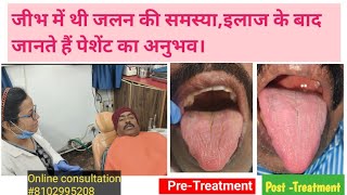 Tongue Burning Sensation Cure in 10 days of treatmentजानते हैं पेशेंट का अनुभव इलाज के बाद जलन कैसा [upl. by Deryl]