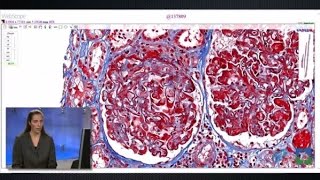 Pathology Insights Medical Kidney Pathology with Leal Herlitz MD [upl. by Pump]