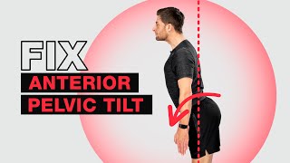 Fix Anterior Pelvic Tilt – Fast [upl. by Deane]