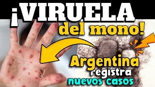 ¡ALERTA ARGENTINA REPORTA INCREMENTO DE CASOS DE MPOX [upl. by Dexter]