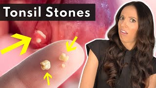 What Are Tonsil Stones amp How To SAFELY Remove Them [upl. by France486]