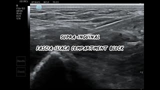 Supra Inguinal FasciaIliaca Block SIFI Block [upl. by Oznarol367]