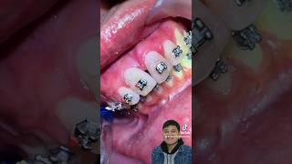 Braces BLACK TRIANGLE [upl. by Ethelinda591]