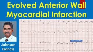 Evolved Anterior Wall Myocardial Infarction [upl. by Orren]