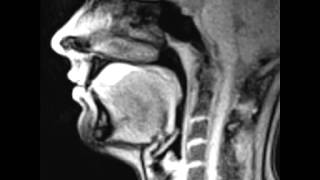 Real time MRI Swallowing Pineapple Juice [upl. by Iccir]