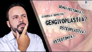 GENGIVOPLASTIA GENGIVECTOMIA CIRURGIA GENGIVAL SAIBA A DIFERENÇA drrowanvilar [upl. by Aissilem]