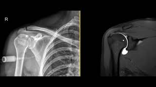 What is an MRI shoulder arthrogram [upl. by Nnaillij]