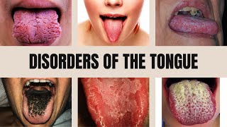 Tongue Diseases Geographic Tongue Black Hairy Tongue Glossitis Thrush and Leukoplakia [upl. by Anerdna474]