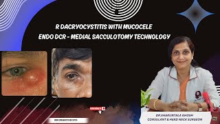 R DACRYOCYSTITIS WITH MUCOCELEENDO DCR  MEDIAL SACCULOTOMY TECHNOLOGY DRSHAKUNTALA GHOSH [upl. by Adon]