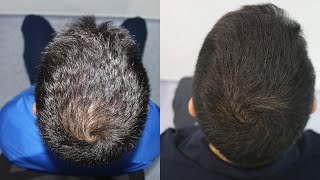 Hair Transplant Result with 2300 Grafts Crown Transplant Receding Hairline [upl. by Yadseut]