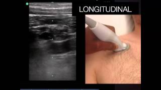 Tutorial Ultrasound Guided Subclavian Line [upl. by Lolita]