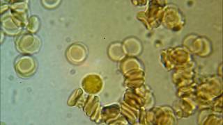 SPIROCHETES  coming out of a WBC [upl. by Auqinahs]