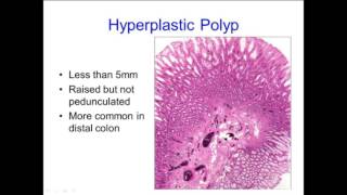 Hyperplastic Polyps Not Always What They Seem [upl. by Aihsemek]