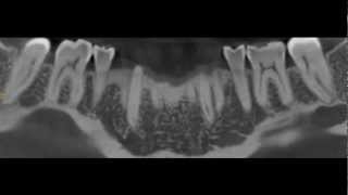 Submandibular gland depression mimicking a dental abcess [upl. by Hartman265]