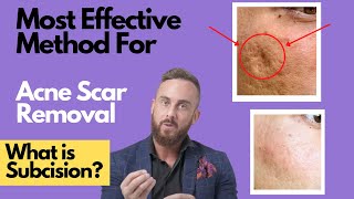 How To Treat DEEP ACNE SCARS  What is SUBCISION [upl. by Ycrep]